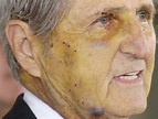 Harry Whittington, shot in face by Dick Cheney, dies at 95