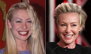 Portia De Rossi Plastic Surgery - With Before And After Photos