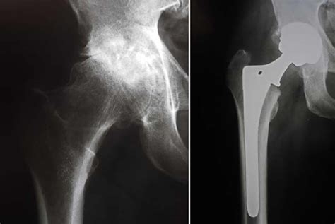 Hip Replacement Surgery Recovery Time Alternatives Risks