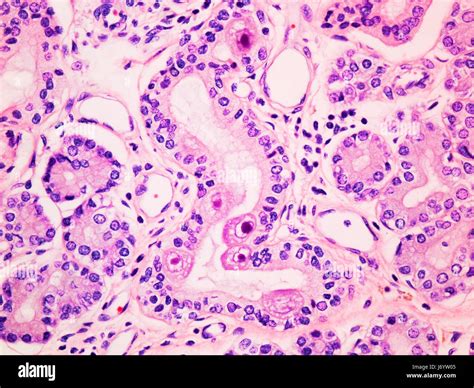 Cytomegalovirus Cmv Infection In The Salivary Gland Viewed At 400x