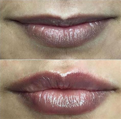 Are You Thinking About Getting Your Lips Enhanced This Before And