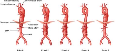 Thoracic Aortic Aneurysm Classification