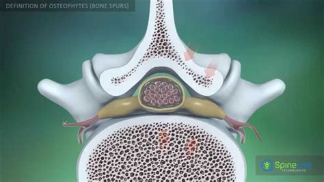 This page is about the various possible meanings of the acronym, abbreviation, shorthand or slang term. Osteophytes bone spurs Definition - YouTube