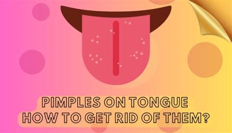 Pimples On Tongue Under On Tip Side Or Back And Getting Rid Of Them