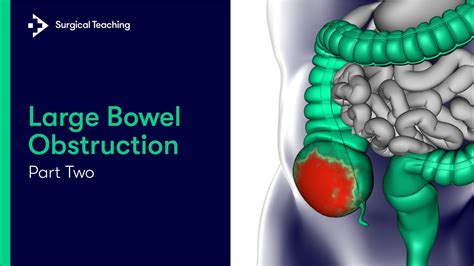 Large Bowel Obstruction Part The Anatomy Of The Large Bowel Youtube