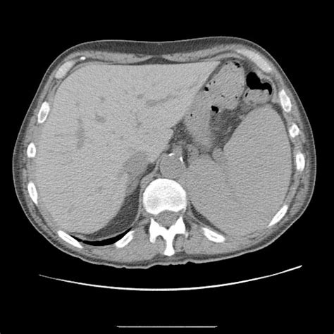 Splenomegaly Ct Wikidoc