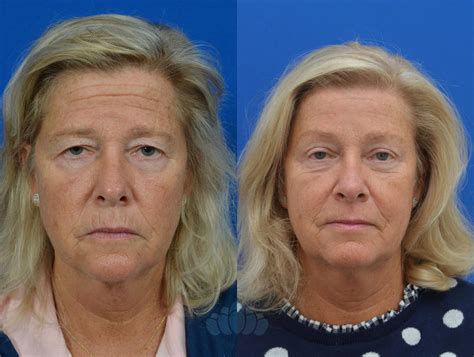 Eyelid Surgery Before And After Pictures Case 71 Charlotte Nc