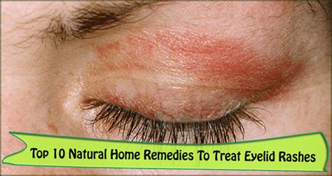7 Causes And Effective Home Remedies To Get Rid Of Eyelid Rashes 2022