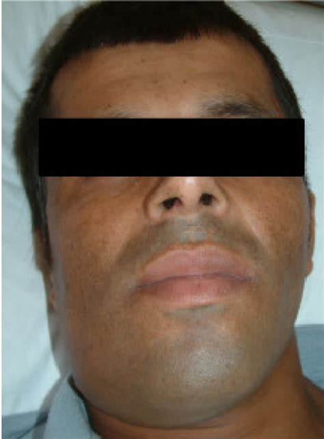 Well Nourished Patient With Swelling Of The Submental And Right