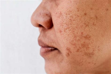 Top 10 Treatments For Sun Damaged Skin Indulgence Medical Day Spa