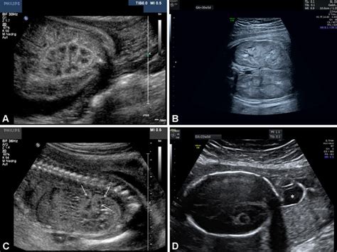 A Enlarged Kidney On Prenatal Ultrasound In The 28 4 Gw The Fetus Is