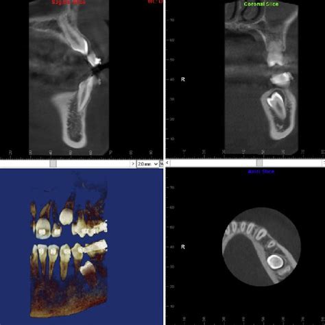 Cbct Images Of Impacted Upper Left Canine And Lower Left Second