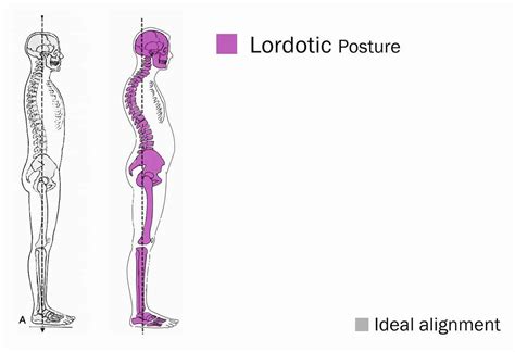 38 Lordosis Treatment Loss Of Cervical Lordosis Exercises