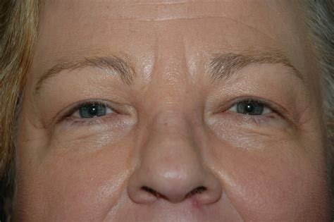 Eyelid Surgery Before And After Photos Texas Facial Plastic Surgery