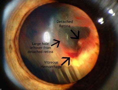 Posterior Vitreous Detachment Everything You Need To Know About