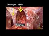 Photos of Esophagus Surgery Recovery Time