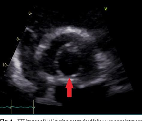 Figure 1 From Conservative Treatment Of Unicuspid Aortic Valve With