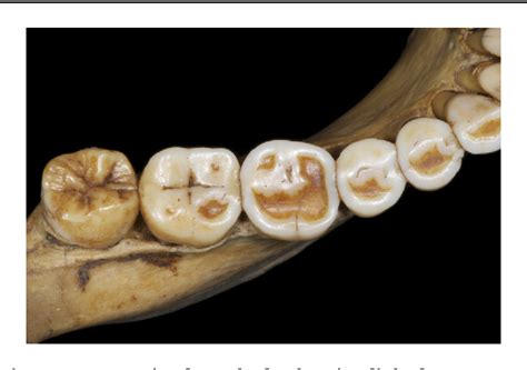 Figure 3 From Human Tooth Wear In The Past And The Present