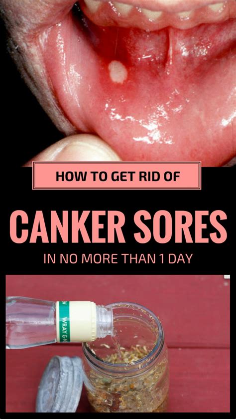 How To Get Rid Of Canker Sores Guide At How To