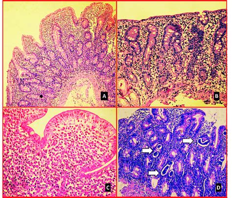 Fig Histological Examination Of Duodenal Biopsies In Patients With