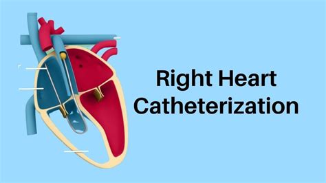 Right Heart Catheterization A Right Heart Catheterization Is A Test