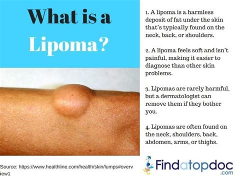 What Is A Lipoma Symptoms And Risk Factors Infographic