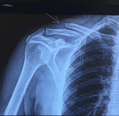 Pre Operative Anteroposterior Radiograph Showing Midshaft Clavicle