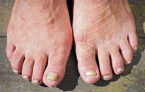 Bare Feet Health Risks Larva Migrans Mrsa Fungal Infection