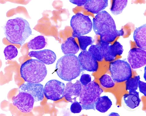 Aml Leukemia Blood Smear Marrow Findings In Jmml