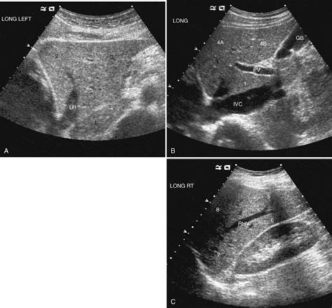 Ultrasound Of The Liver Biliary Tract And Pancreas Abdominal Key
