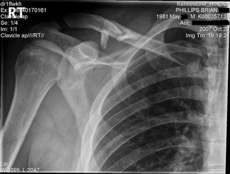Broken Collar Bone Recovery Time Pinkbike Forum