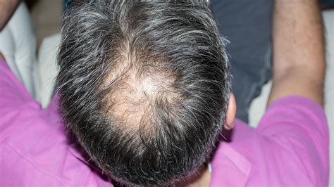 Alopecia Cuáles Son Los Tratamientos Más Eficaces Contra La Caída Del