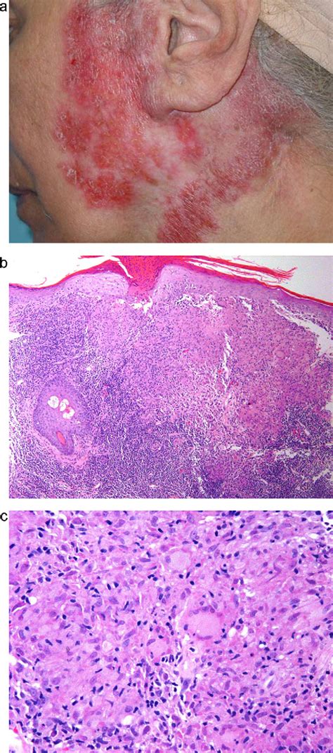 A Case Of Lupus Vulgaris Showing A Large Infiltrated Reddish Plaques