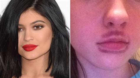 Bruised Lips From Kylie Jenner Challenge