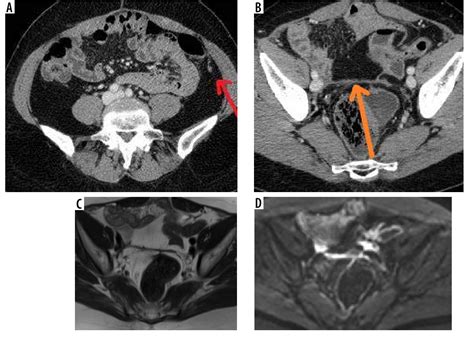 Figure 1 From Diagnosis And Treatment Of Peritoneal Carcinomatosis A