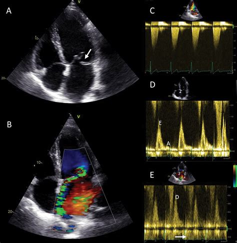 Mitral Valve Imaging With Ct Relationship With Transcatheter Mitral
