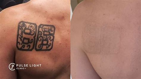 Details 97 About Tattoo Removal Before And After Super Hot Indaotaonec