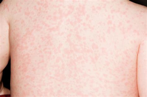 Measles Rash On The Back Photograph By Dr P Marazziscience Photo Library