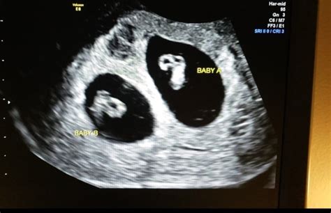 After Multiple Miscarriages Years Of Heartbreak We Now Have Twins
