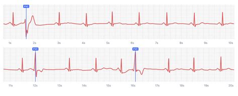 QALY What Heart Palpitations And Ectopic Beats Look Like On Your