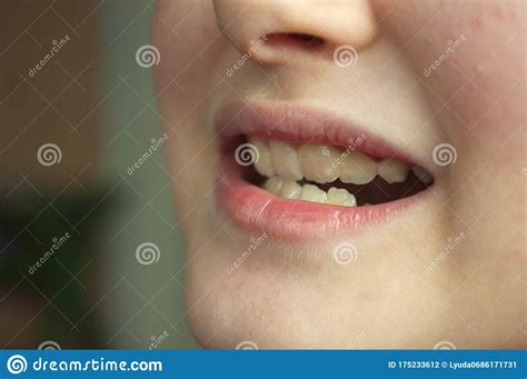 Crooked Teeth In A Child Stock Photo Image Of Enamel 175233612