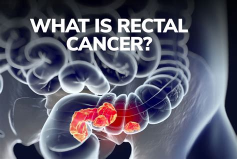 What Is Rectal Cancer Gastro Md