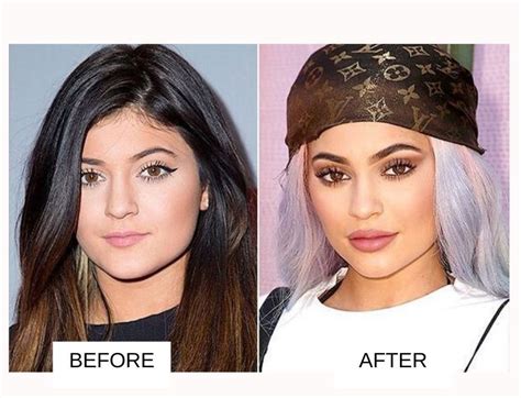 Kylie jenner is a knockout alright, but the reality tv star took pains to enhance her appearance with plastic surgery. Kylie Jenner Plastic Surgery: Before And After Images ...