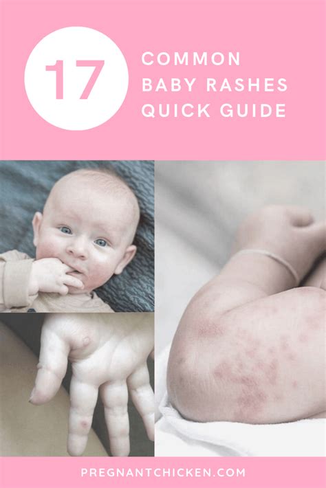 Types Of Baby Rashes Artofit