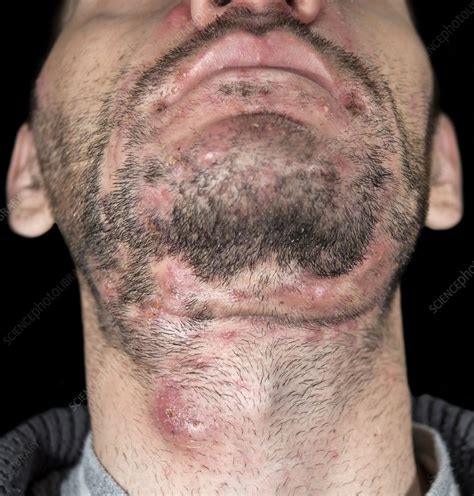 Cystic Acne And Dissecting Folliculitis Stock Image C0180324