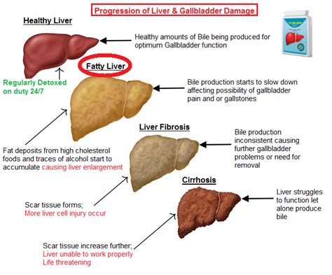 7 Signs Symptoms Of Fatty Liver Disease