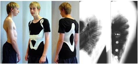 A Good In Brace Correction In A Patient With Rigid Kyphosis In A