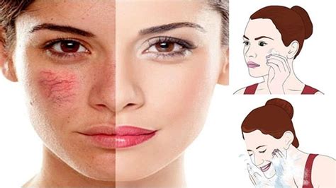 How To Get Rid Of Broken Capillaries On Your Face Naturally Broken
