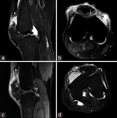 Simultaneous Bilateral Quadriceps Tendon Rupture In A Patient On Hemodialysis A Case Report