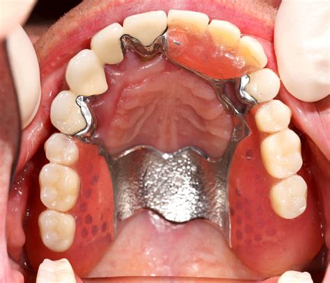 Partial Dentures Perth Acrylic And Chrome Dentures Plus